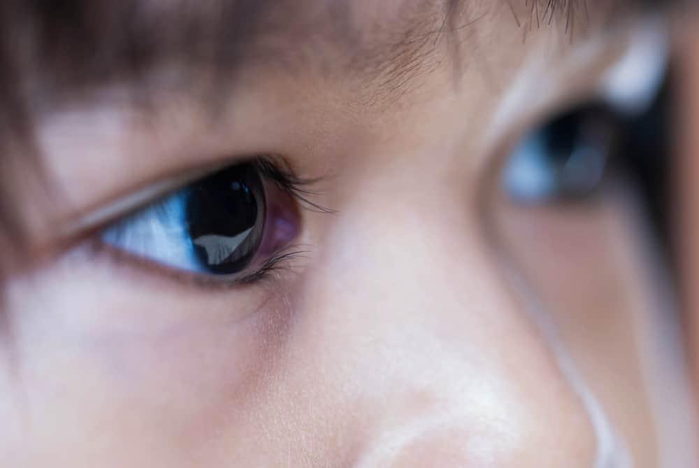 retinoblastoma
