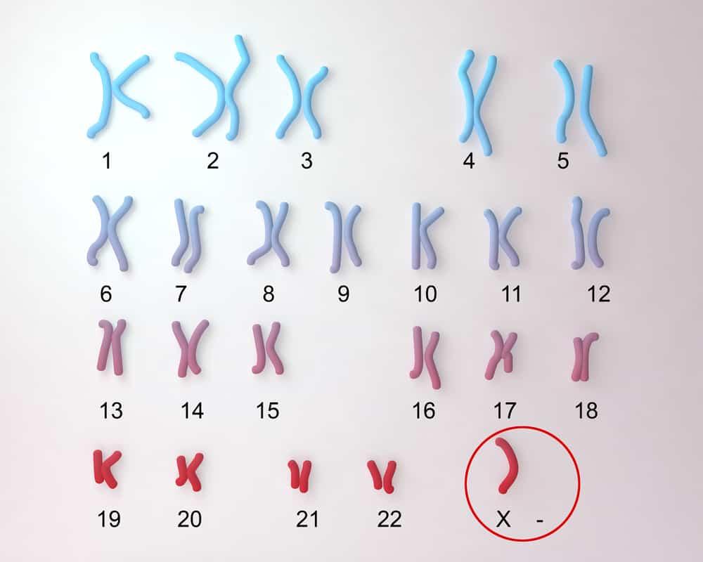 sindrom-turner-syndrome
