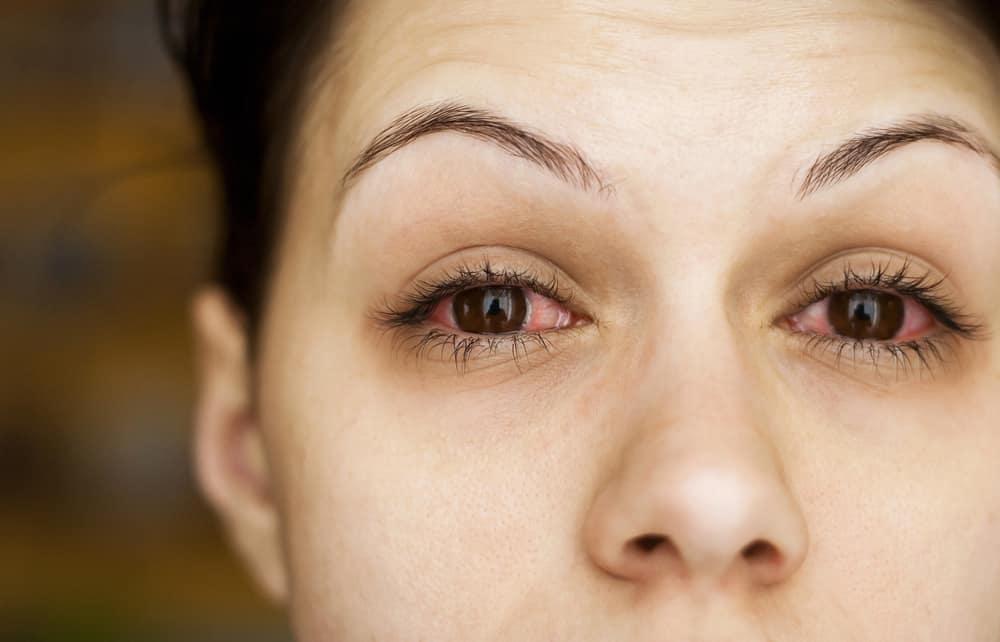 sjogren-syndrome