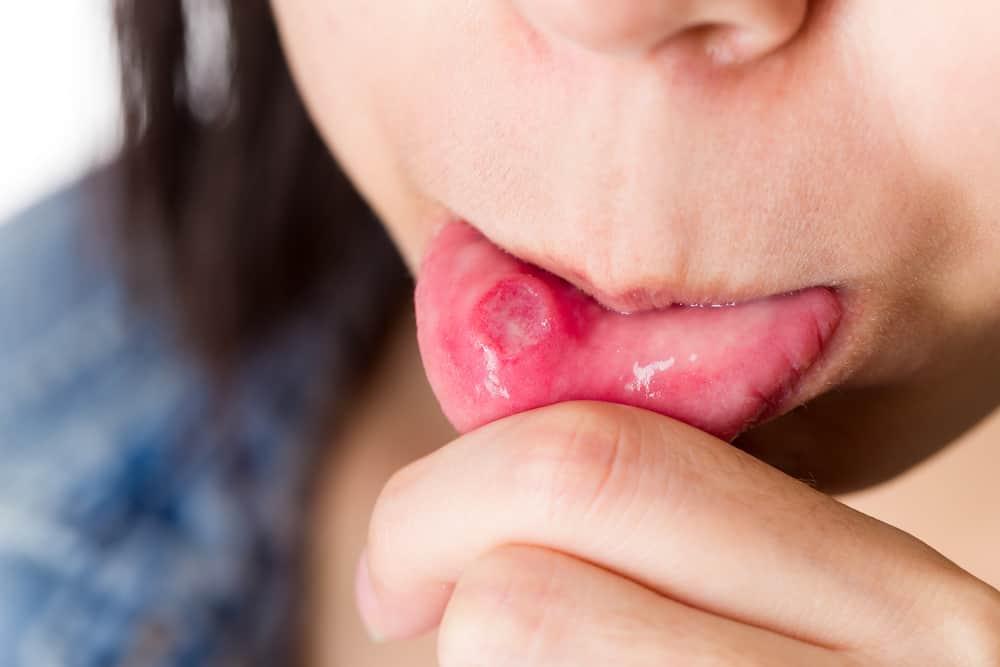 stomatitis