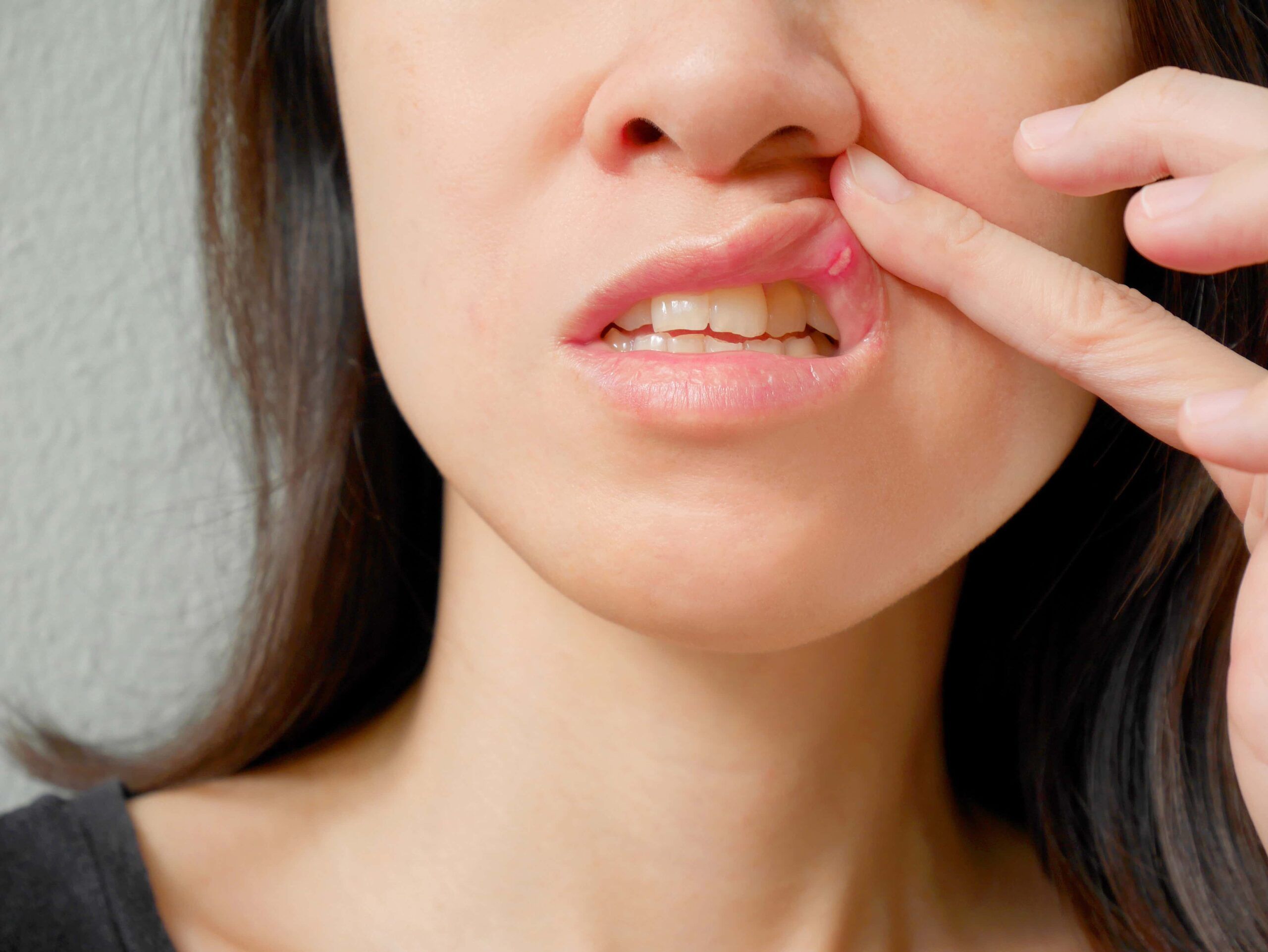 radang-mulut-mouth-sprue