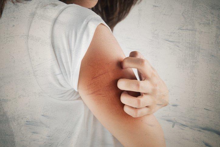 dermatitis-atopik