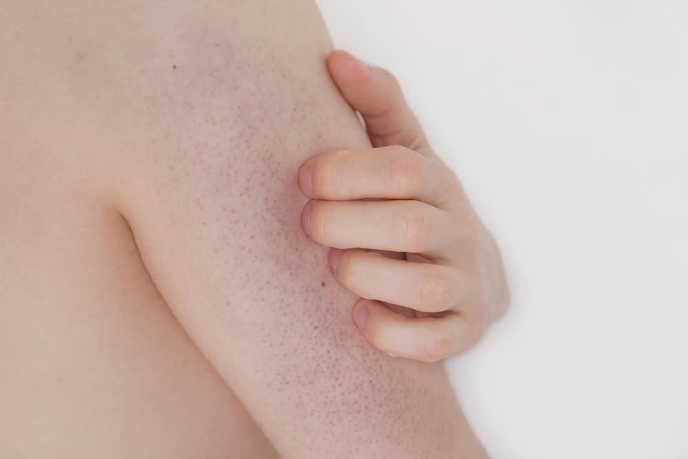 keratosis-pilaris