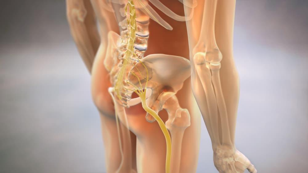 Sciatica