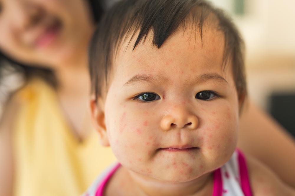 Memahami Penyakit Campak, Munculnya Ruam Kulit Akibat Infeksi Virus