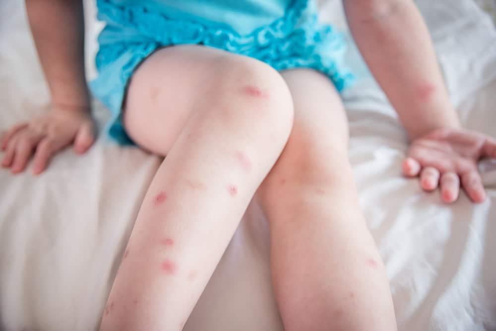 Impetigo