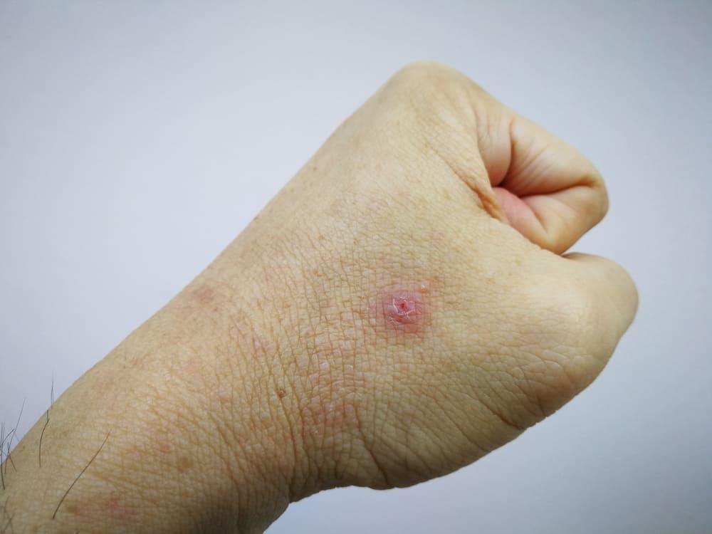 molluscum-contagiosum