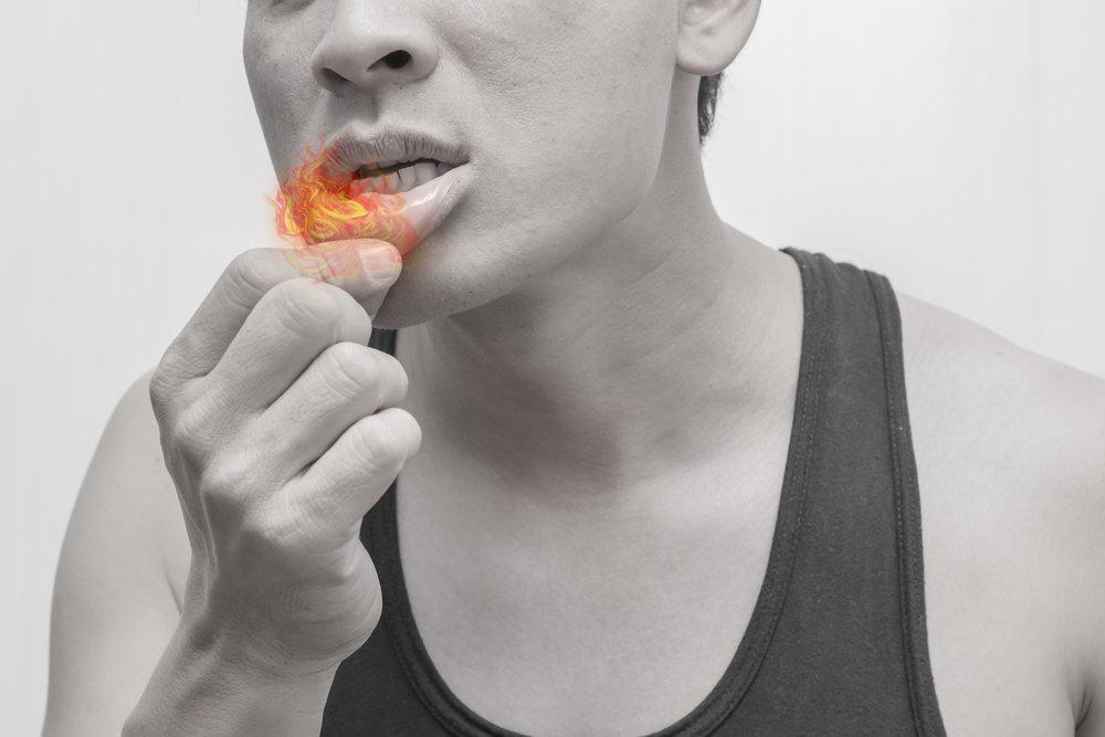penyebab-gejala-mengatasi-sariawan-hiv