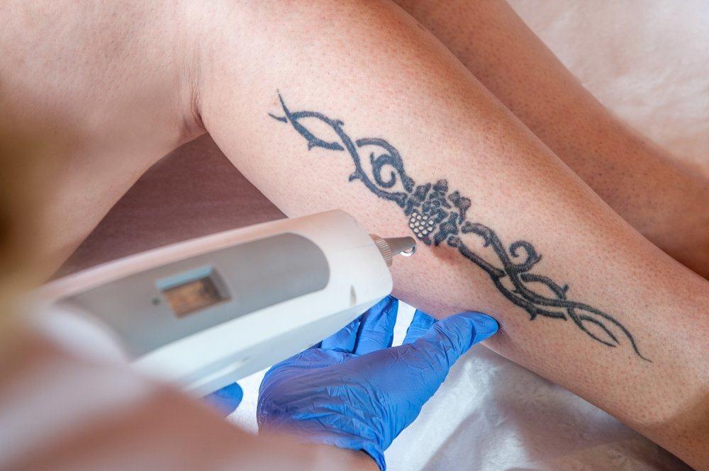 efek-samping-menghapus-tato-dengan-laser