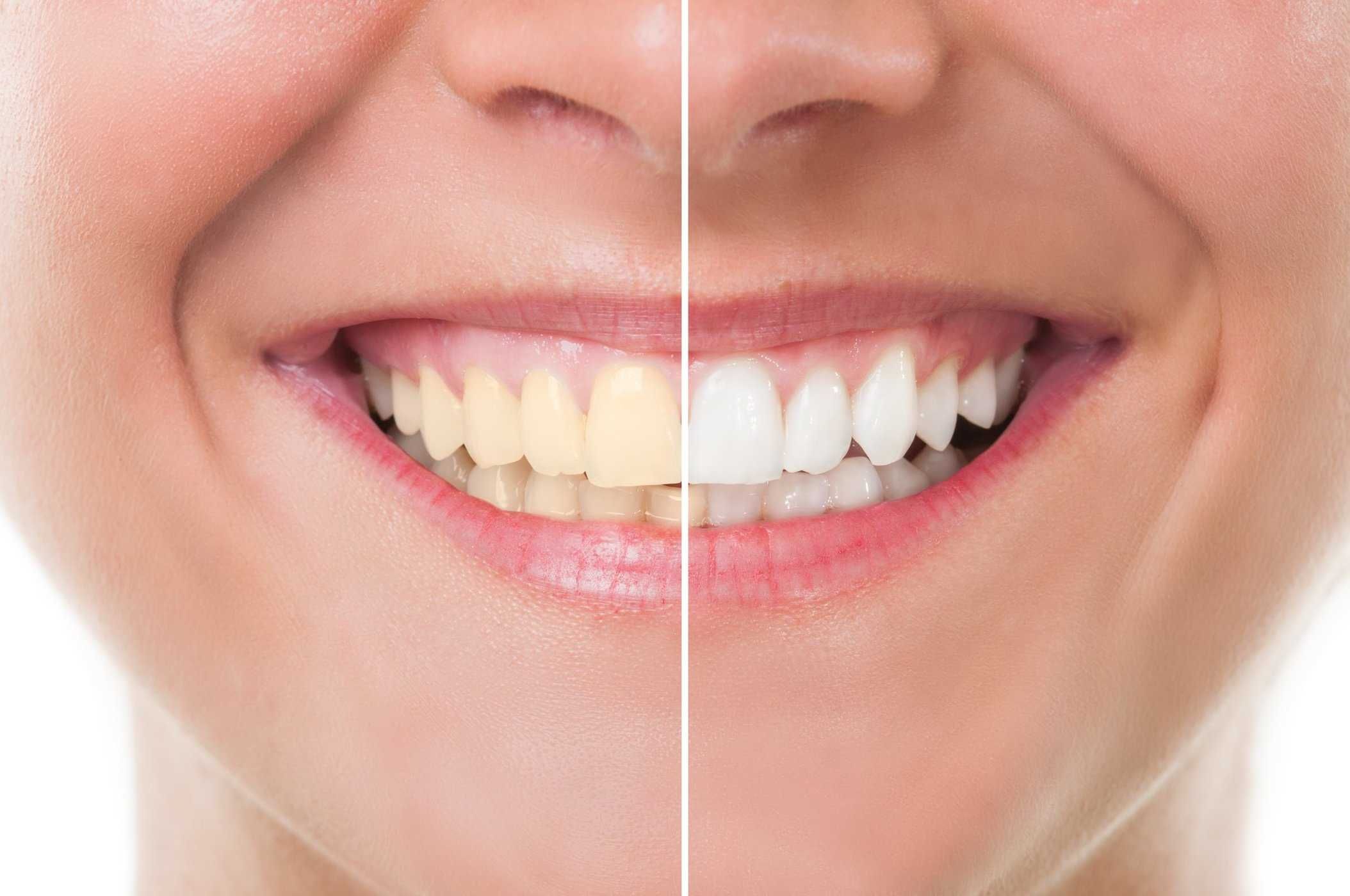 Efek Bleaching untuk Memutihkan Gigi, Adakah yang Perlu Diwaspadai?