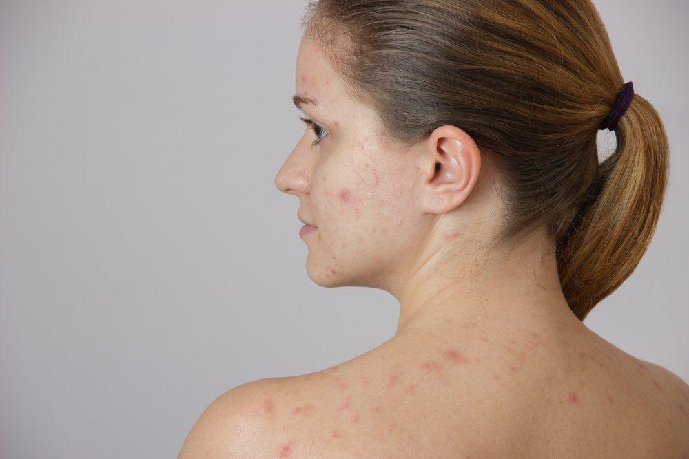 penyakit-herpes-zoster-risiko-stroke