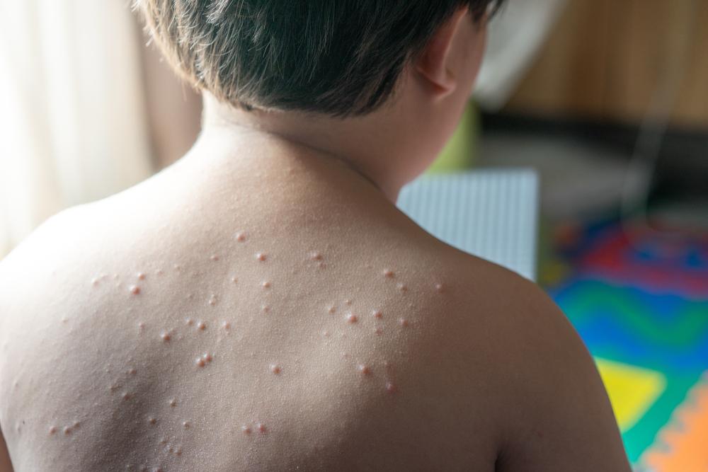 cara-menghilangkan-gatal-cacar-air