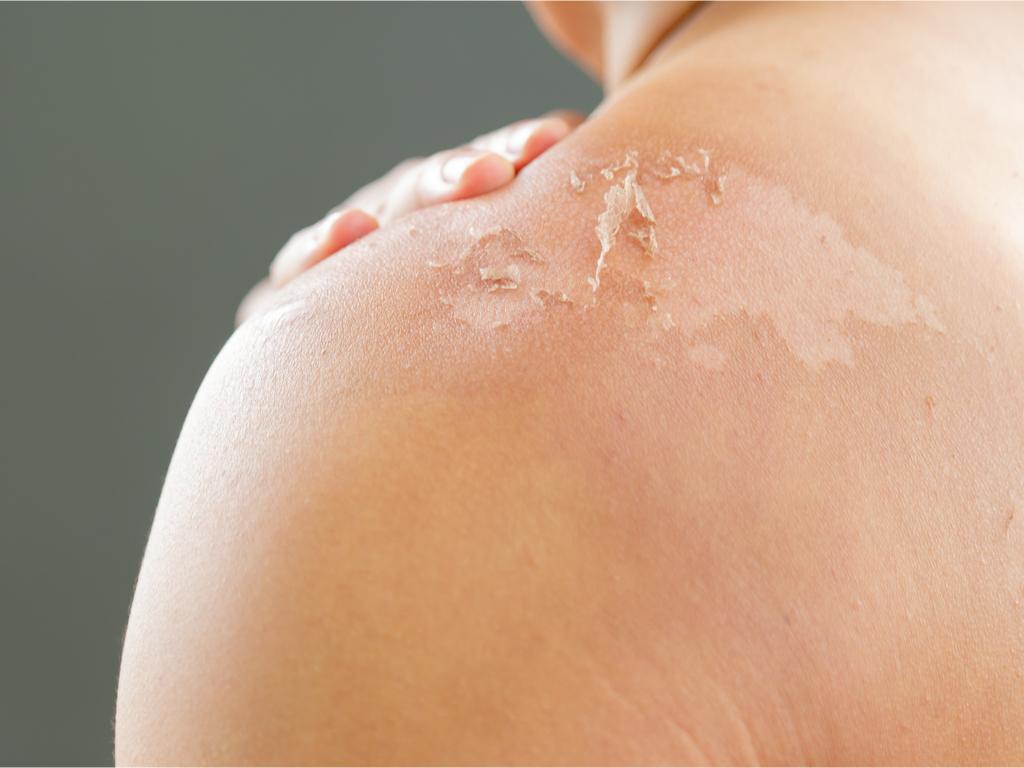 Ganti Kulit Pada Manusia, Apakah Ini Normal?