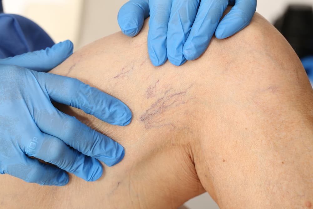 Memahami Apa Itu Spider Vein di  Permukaan Kulit, Serta Cara Mengatasinya