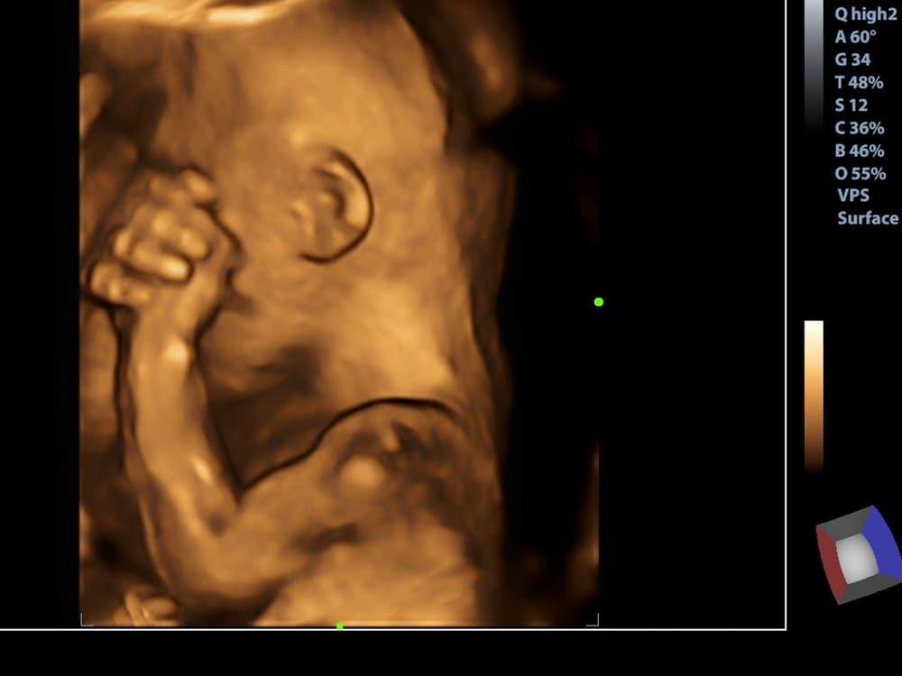 usg-3d-dan-4d-apa-bedanya