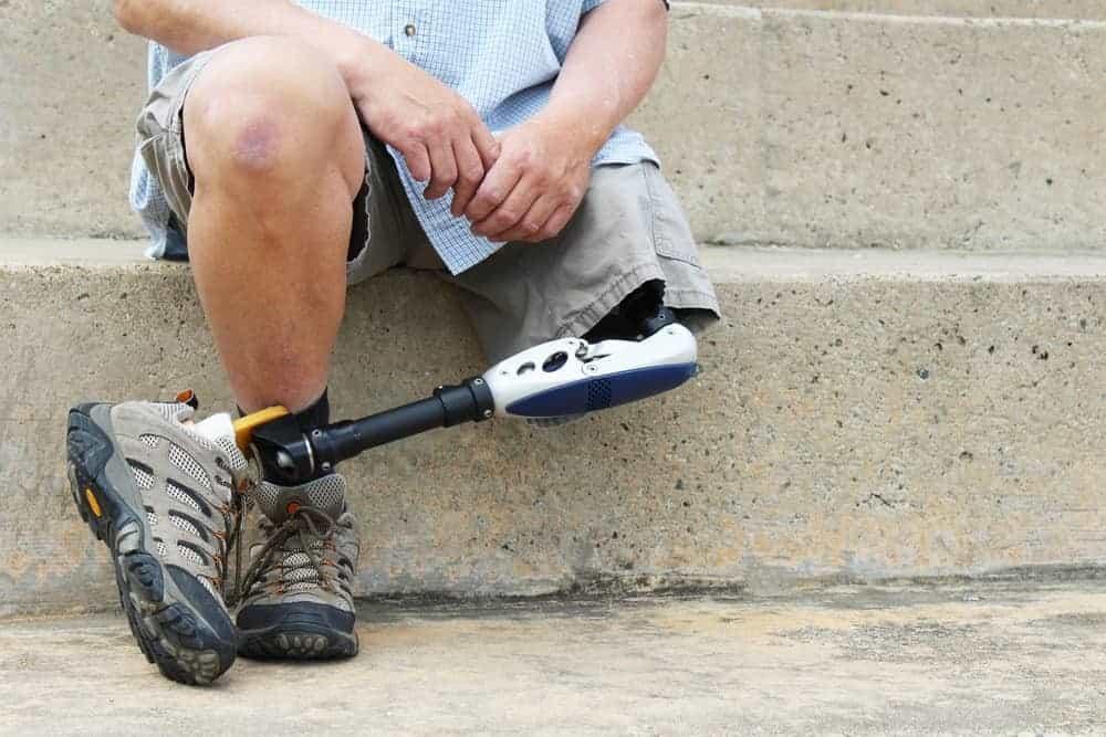 Sakit pada Kaki Padahal Sudah Amputasi, Kok Bisa?