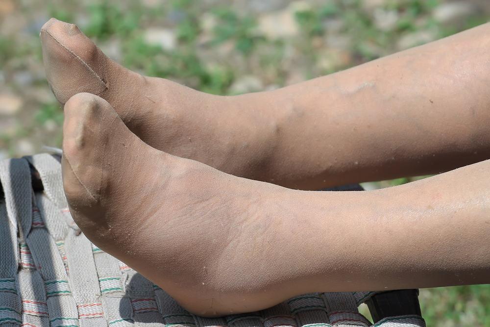 10 Penyebab Kaki Bengkak dan Cara Mengatasinya
