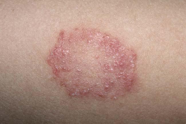 gatal-kurap-dan-infeksi-jamur-candida