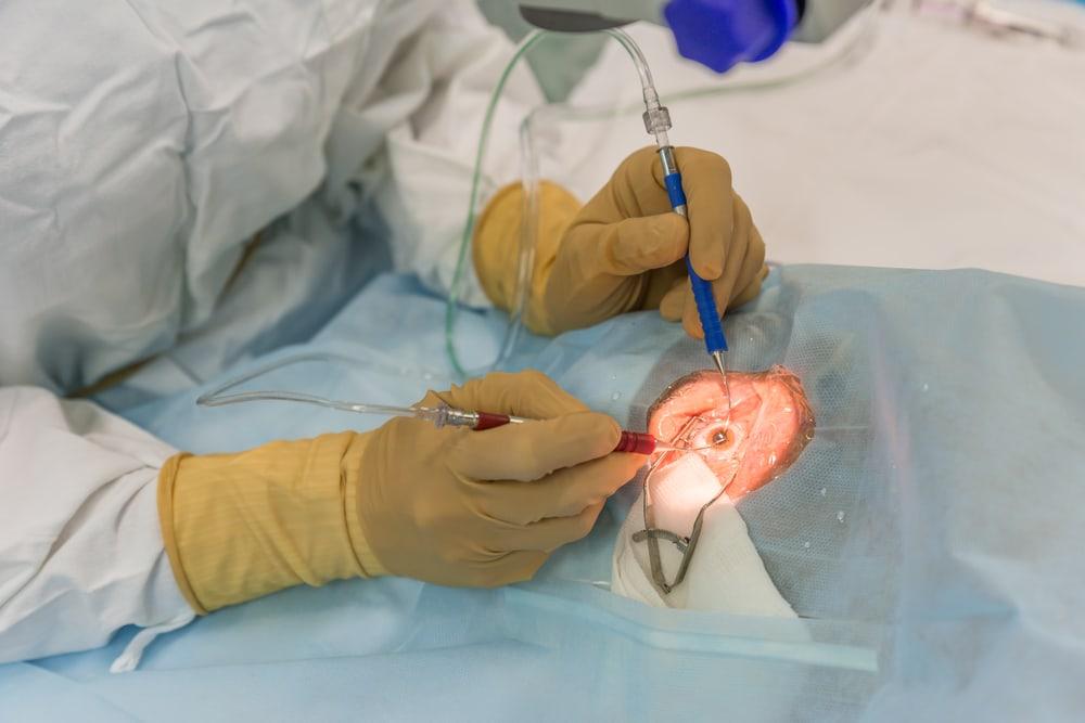 6 Komplikasi yang Mungkin Terjadi Akibat LASIK