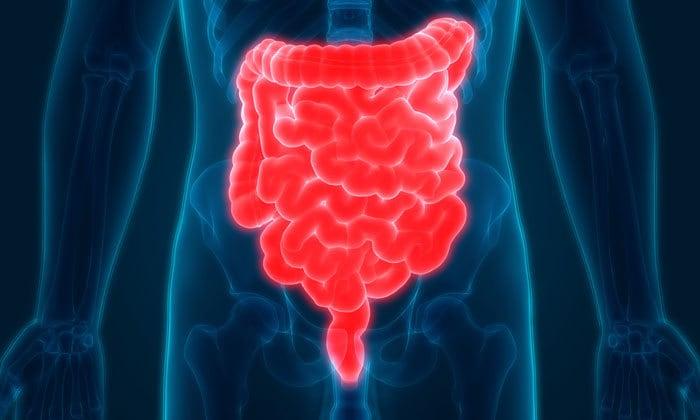 pseudomembranous-colitis