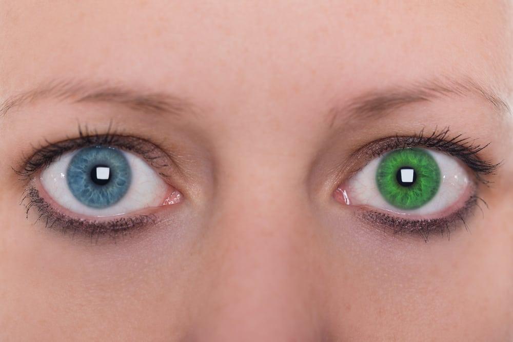heterochromia