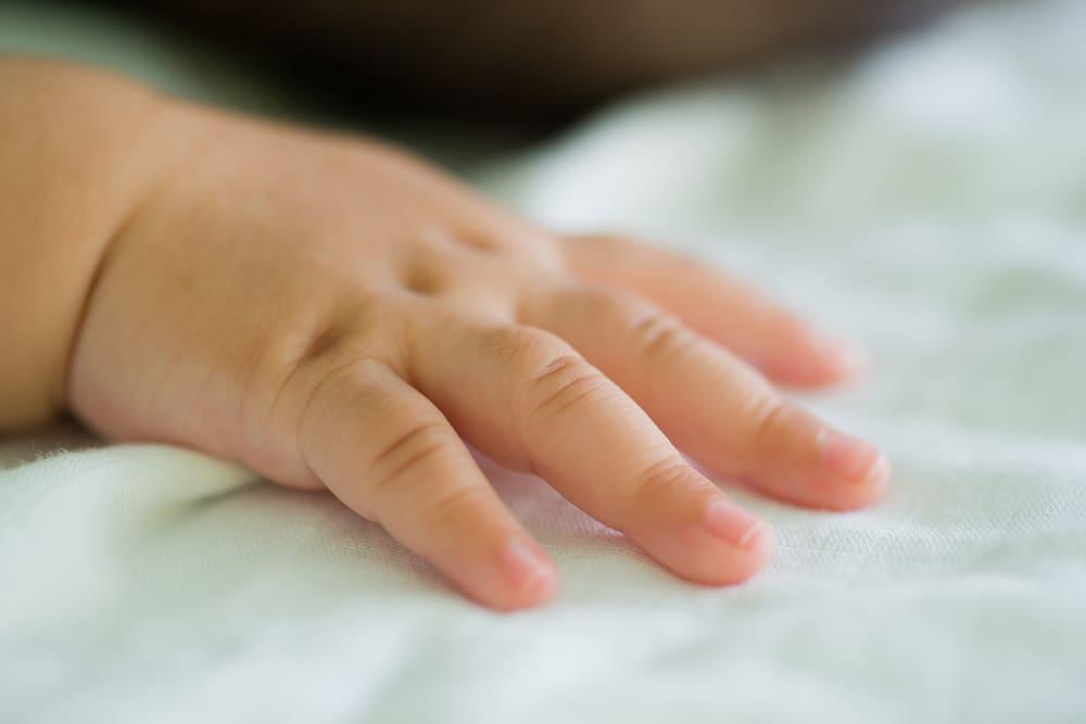 sindaktili-jari-dempet-pada-bayi