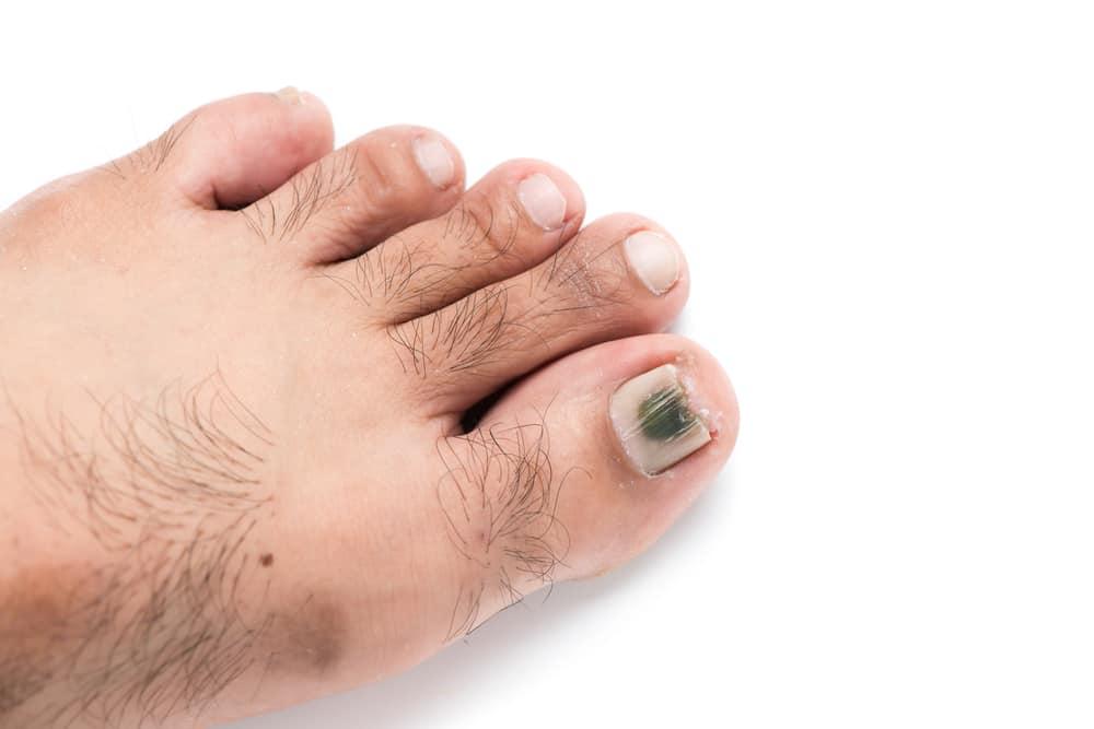 5 Penyebab Kuku Kaki Berubah Warna Jadi Menghitam