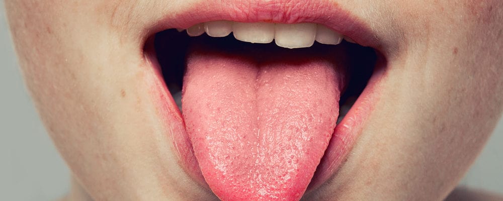 7 Penyebab Lidah Kuning Plus Cara Jitu Mengatasinya