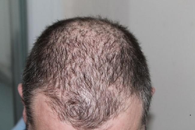 Benarkah Stres Bisa Menyebabkan Rambut Botak?