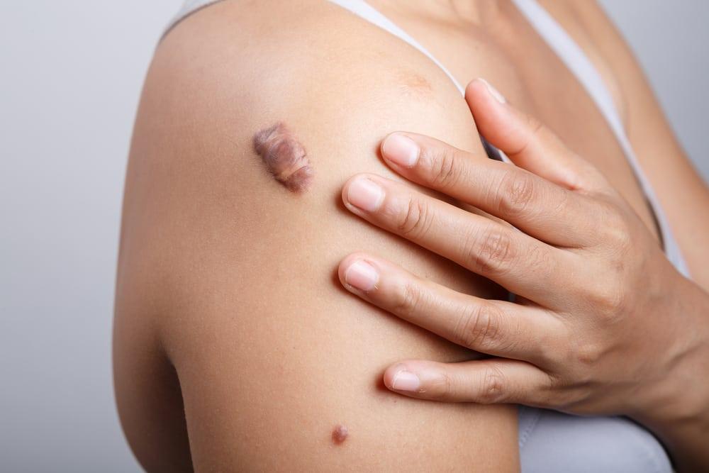 Bisakah Mencegah Keloid Tumbuh Pada Bekas Luka?