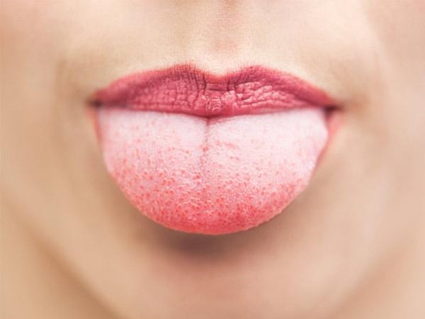 Berbagai Jenis Penyakit Lidah yang Bisa Dideteksi dari Warnanya