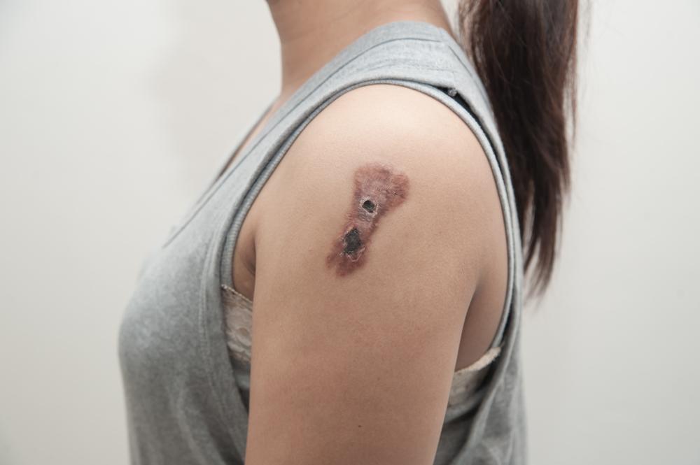 tahapan-stadium-kanker-kulit-melanoma