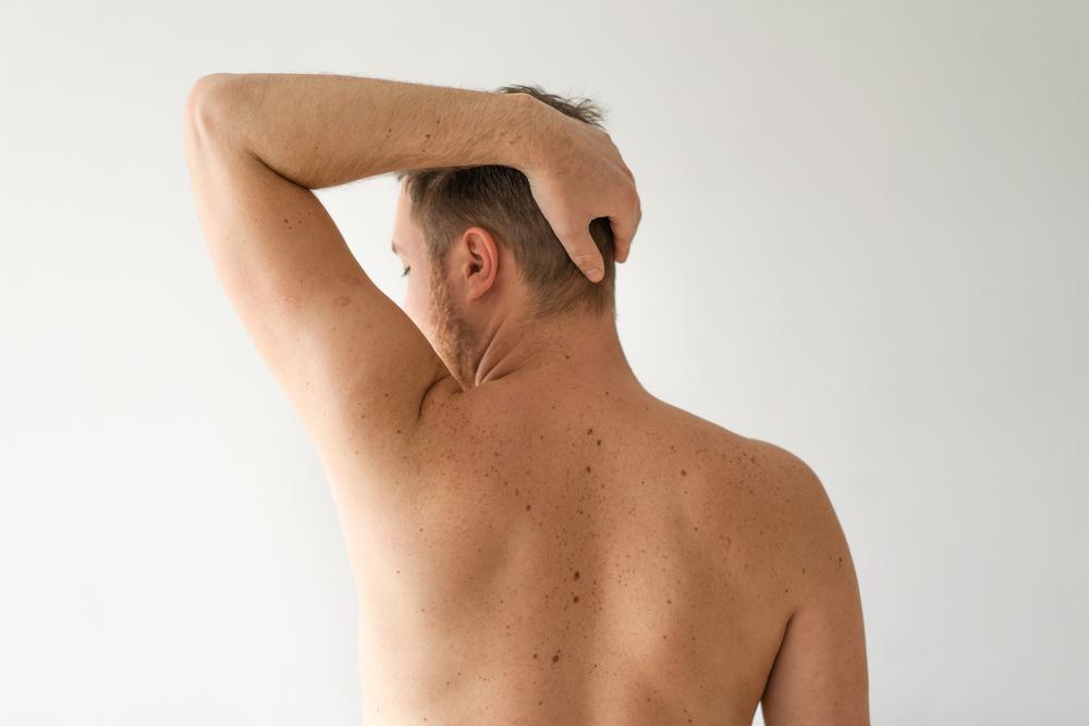 bercak-cokelat-seperti-panu