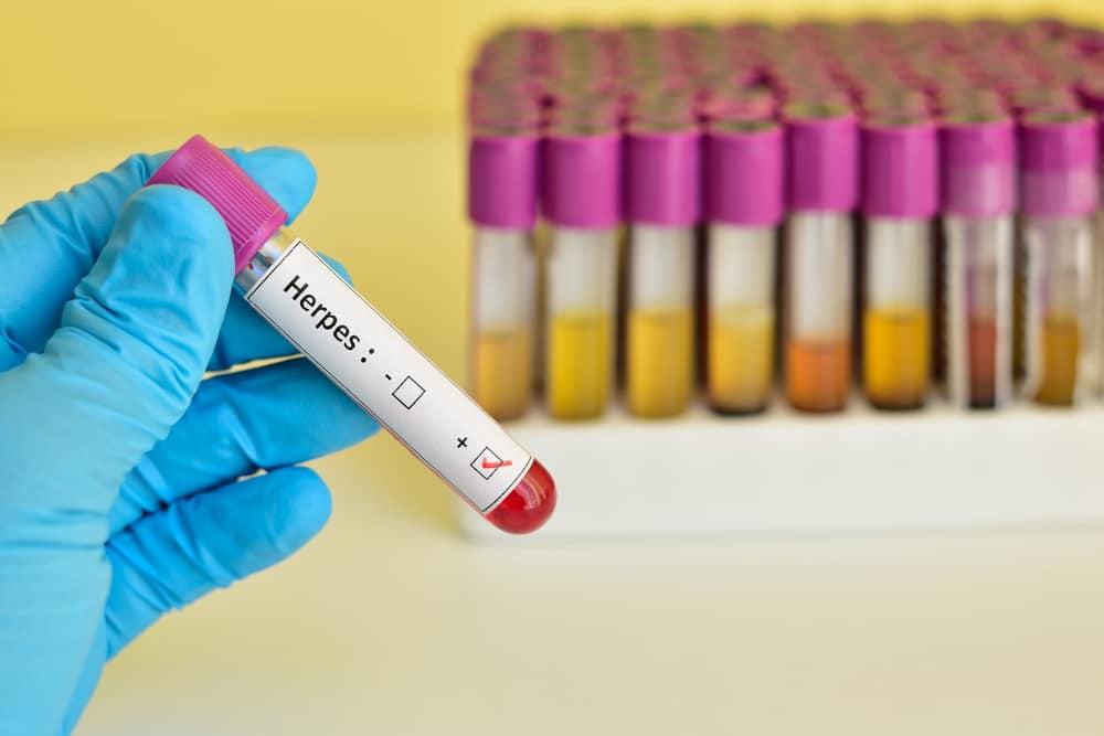 cara-penularan-herpes-simplex