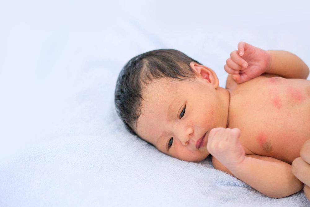bentol-merah-pada-kulit-bayi