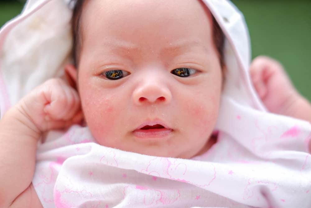Serba- Serbi Jerawat pada Bayi yang Tidak Perlu Dikhawatirkan