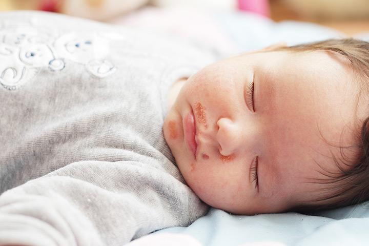 Mengenal Impetigo, Kondisi Kulit Melepuh Seperti Cacar Air pada Bayi