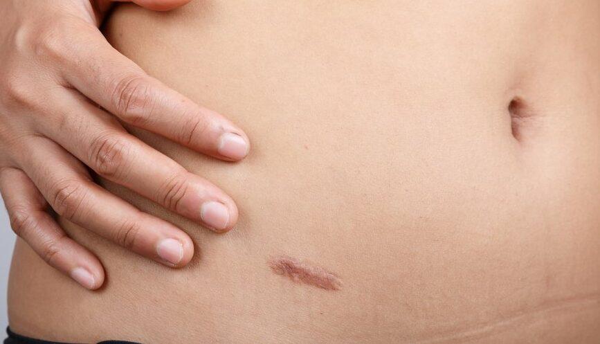 komplikasi-pasca-operasi-usus-buntu