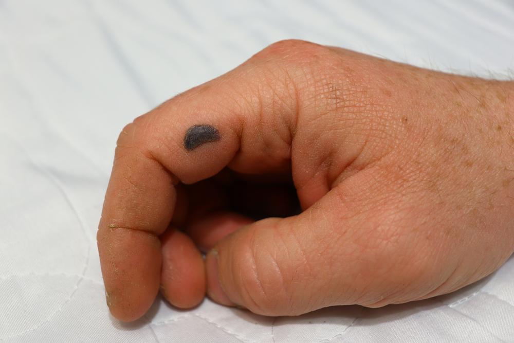 Blood Blister, Munculnya Darah dari Dalam Kulit dan Tidak Mengalir