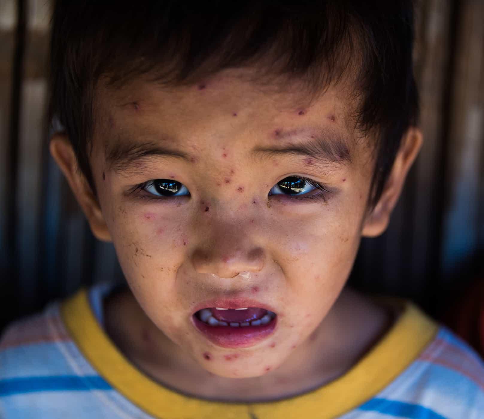 komplikasi-penyakit-cacar-air