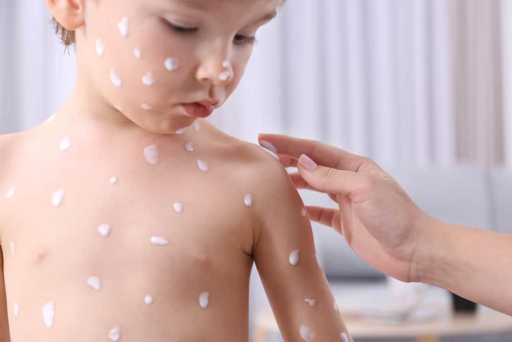 5 Hal yang Harus Dilakukan Saat Anak Kena Cacar Air