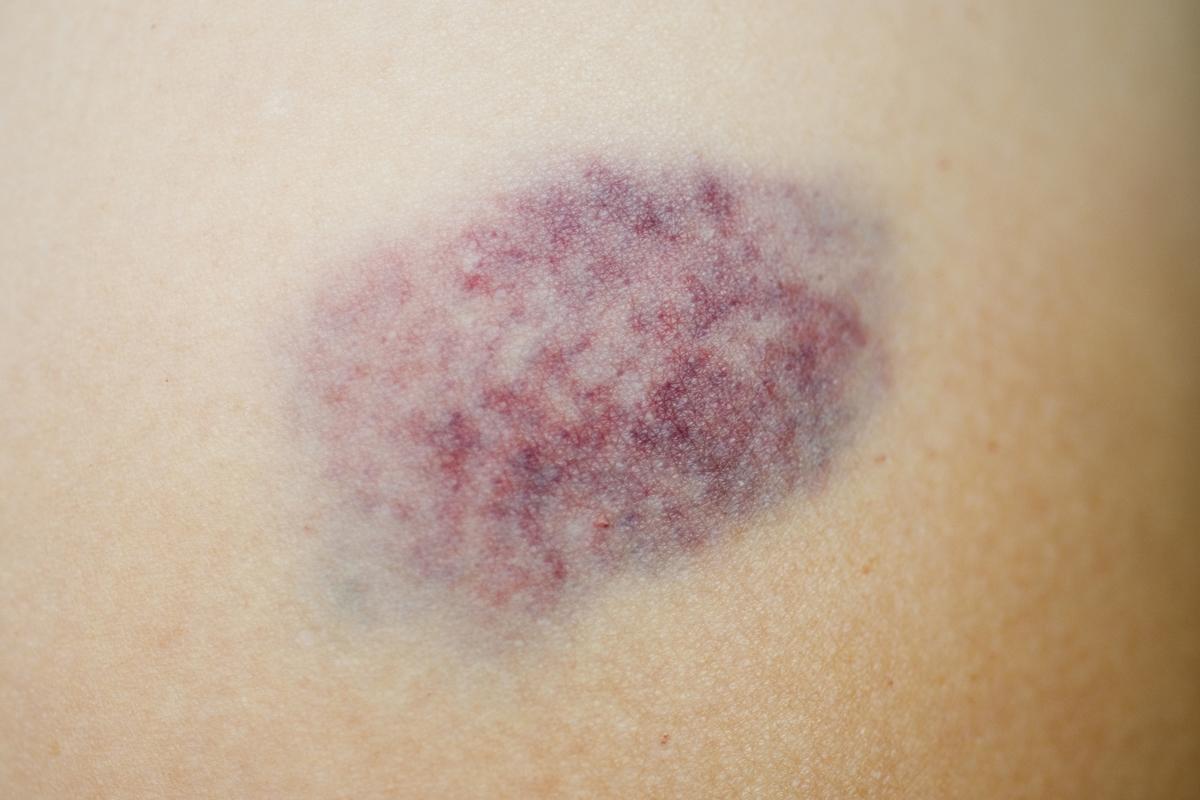 hematoma