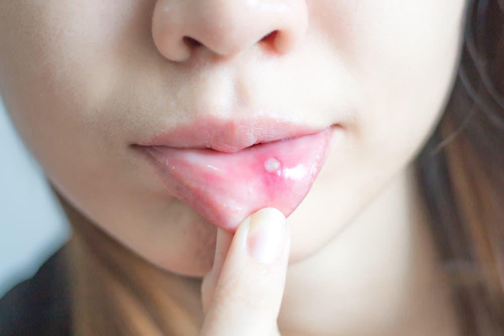 infeksi-virus-hpv-di-mulut-oral