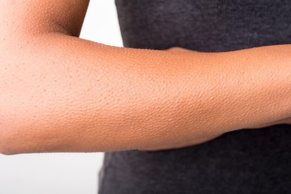 Mengenal Keratosis Pilaris, Kondisi Kulit Dengan Bintik-bintik Kecil Seperti Kulit Ayam