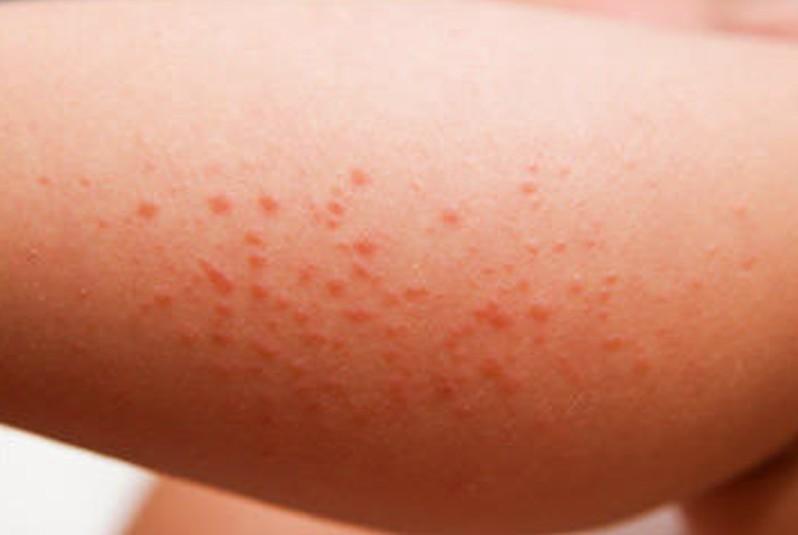 Myelodysplastic Syndrome (Praleukemia)