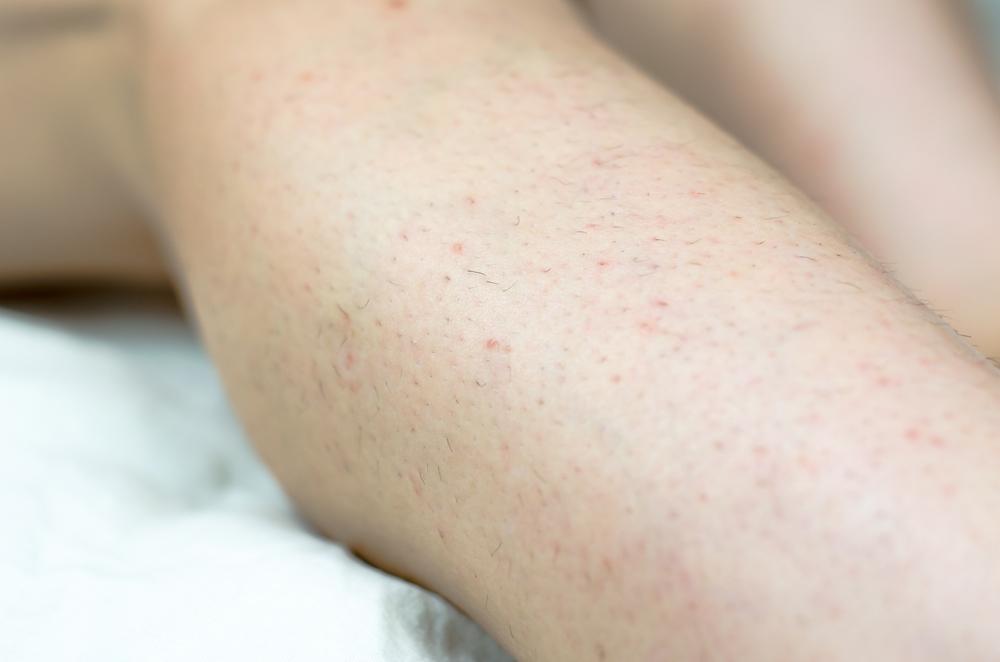 merawat-rambut-kemaluan-tumbuh-ke-dalam