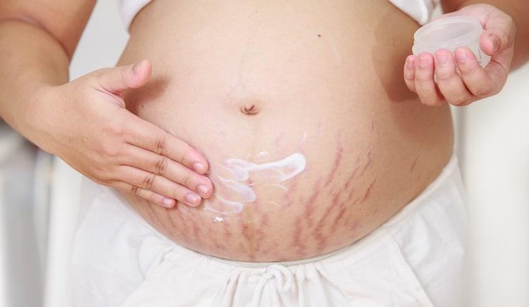 5 Minyak Esensial Terbaik untuk Menghilangkan Stretch Mark