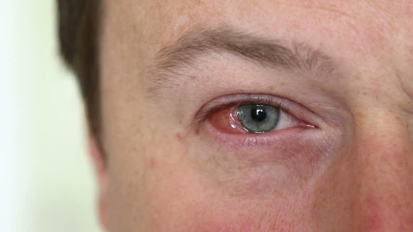 gejala-herpes-mata-keratitis