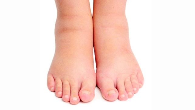 Edema Idiopatik