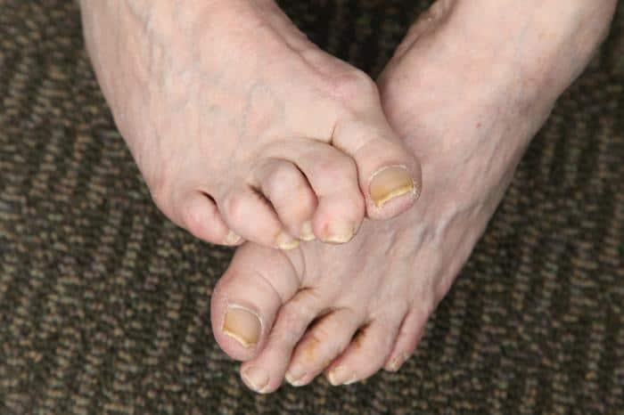 hammertoe